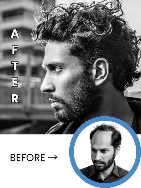 Before and after men's hair restoration at National Hair Centers