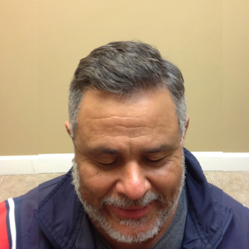 Male client after hair system