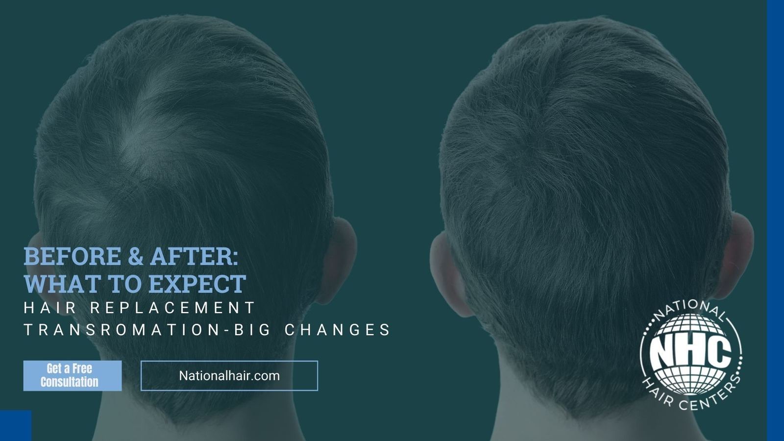 Before & After: What to Expect from a Hair Replacement
