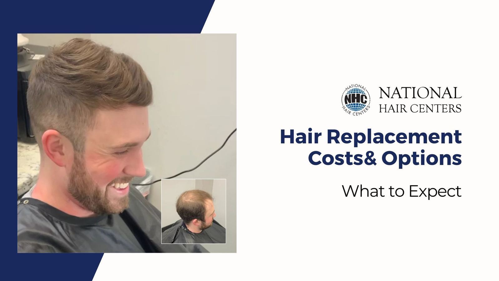 Hair Replacement Costs: What to Expect