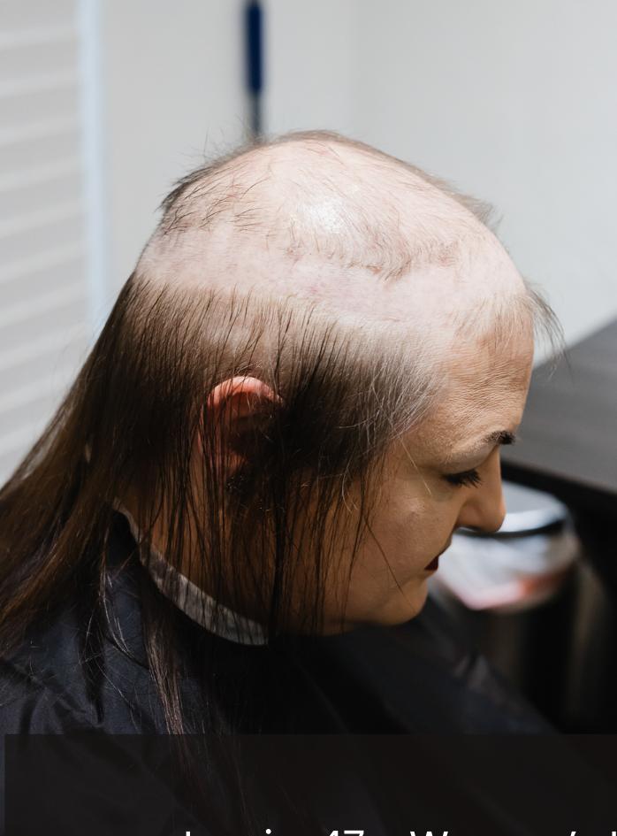 Female client before hair replacement