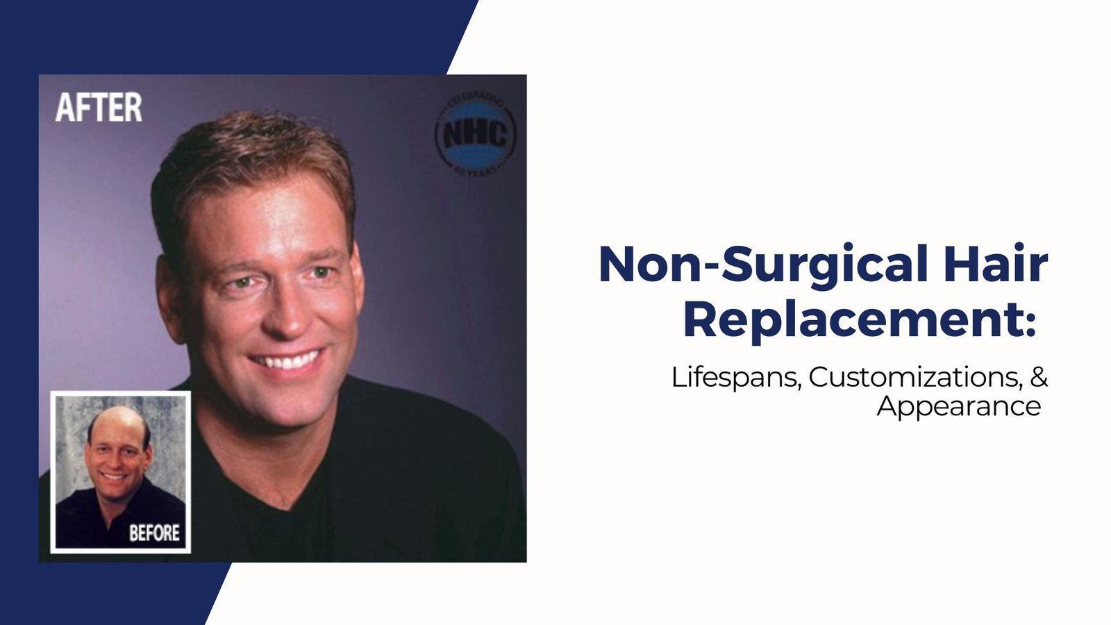 Hair Replacement Systems: Lifespans, Customizations, &