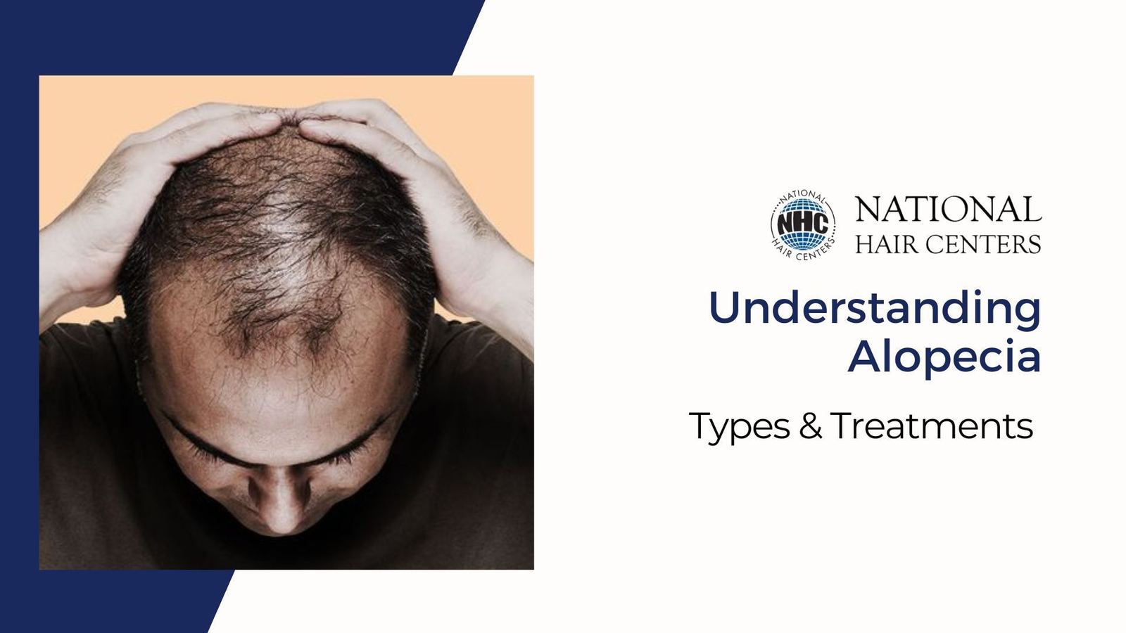 Understanding Alopecia: Types & Treatments