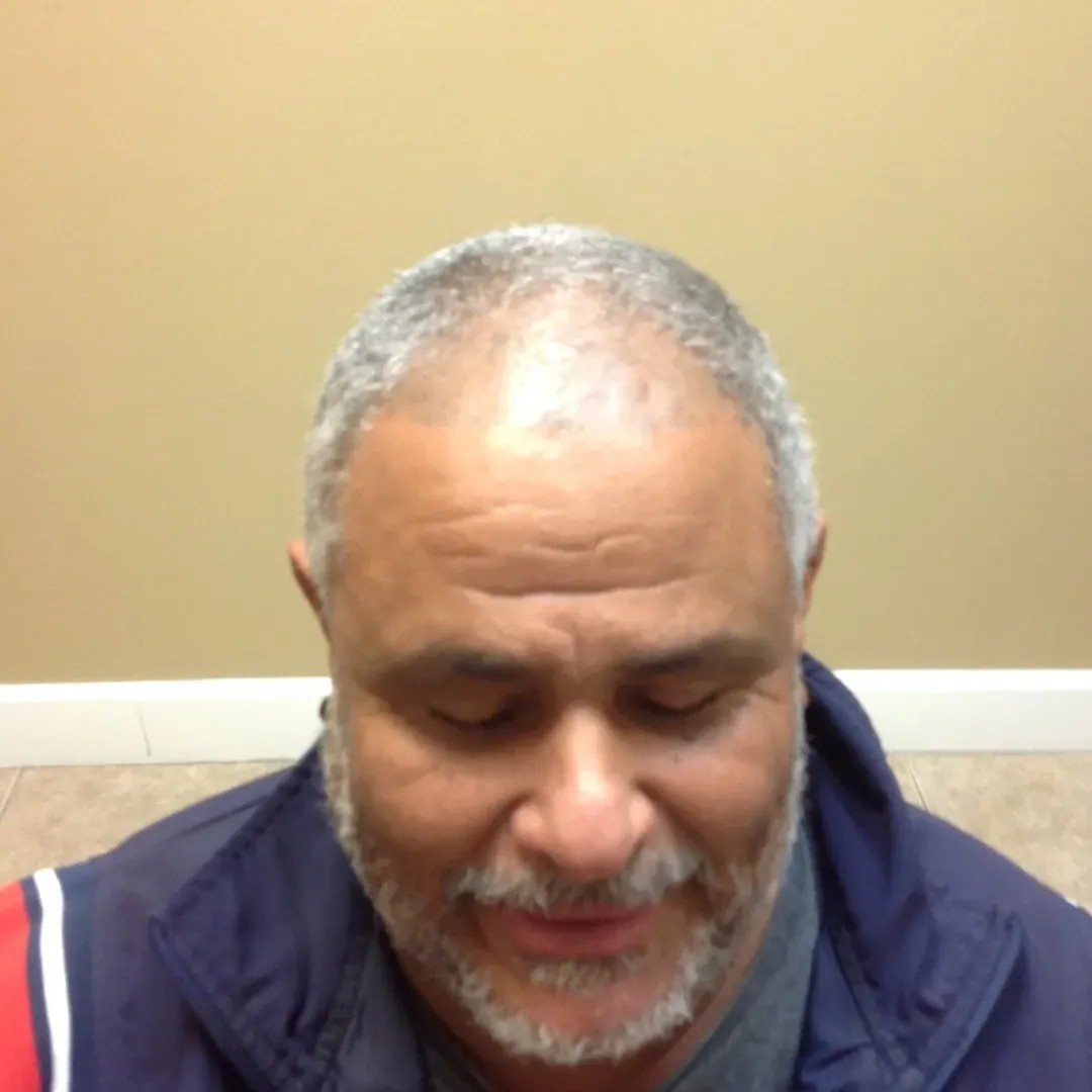 Male client before hair system