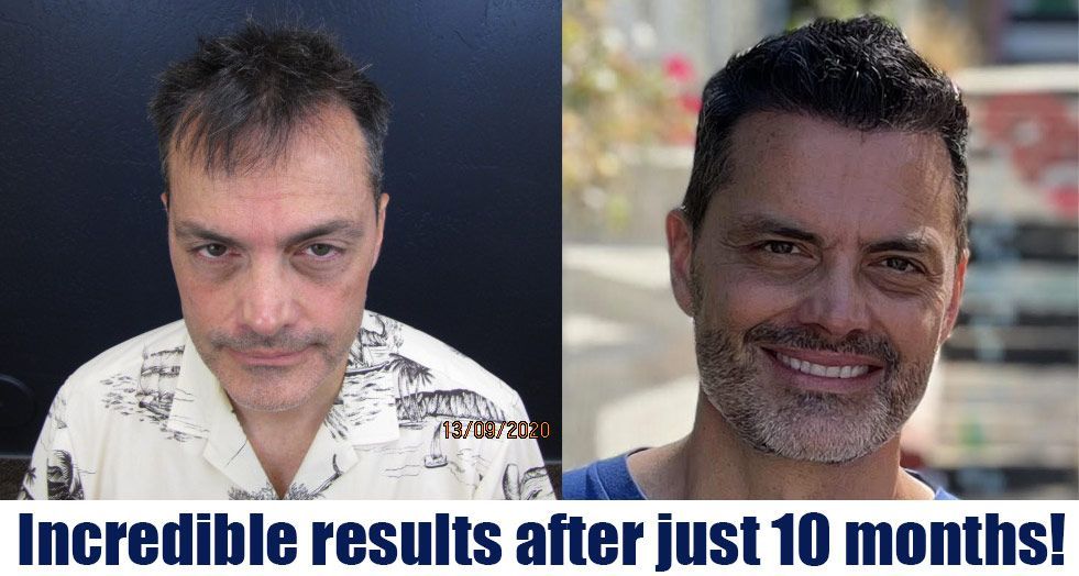 Hair transplant before and after results at National Hair Centers in Phoenix