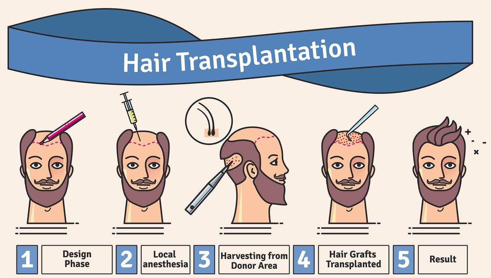 How hair transplants work - physician performing hair transplant surgery