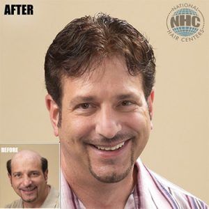 Before hair replacement treatment showing hair loss