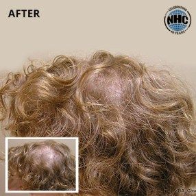 Laser hair therapy before and after results