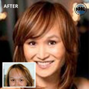 After hair replacement treatment showing full natural hair