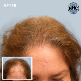 Hair transplant before and after - female patient