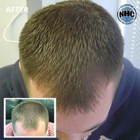 Laser hair therapy before and after results