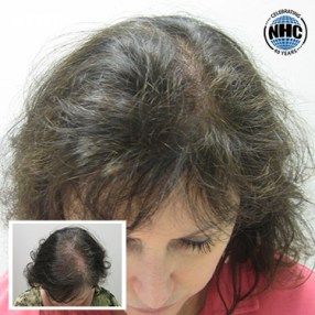 Laser hair therapy before and after results