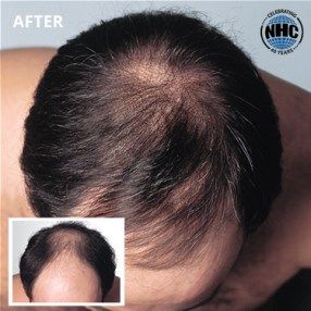 Laser hair therapy before and after results