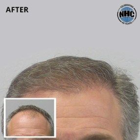 Hair transplant before and after - top of head