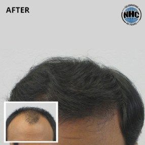 Hair transplant before and after - receding hairline