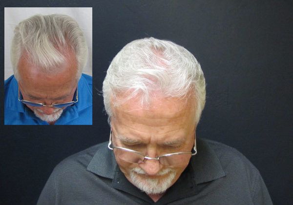 Hair transplant before and after - crown area