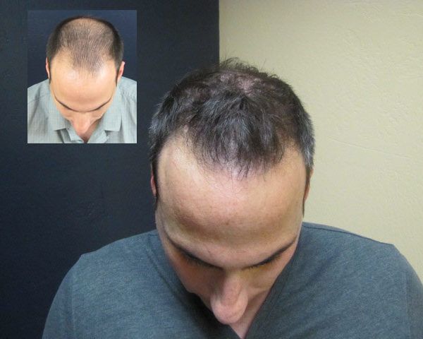 Hair transplant before and after results