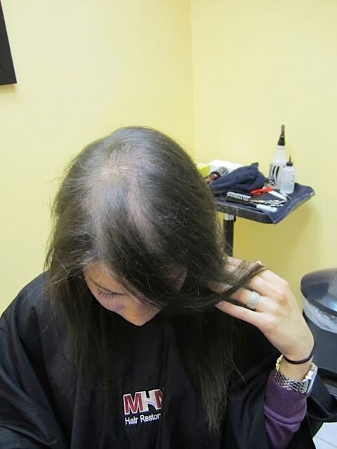 A close-up trichology scalp examination checking hair follicles for signs of autoimmune-related hair loss