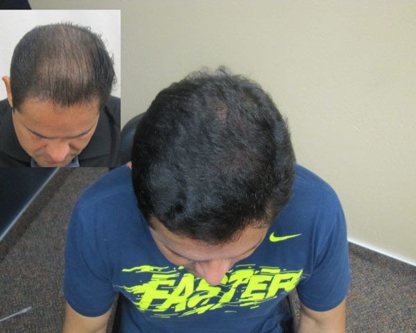 Hair transplant before and after - male patient