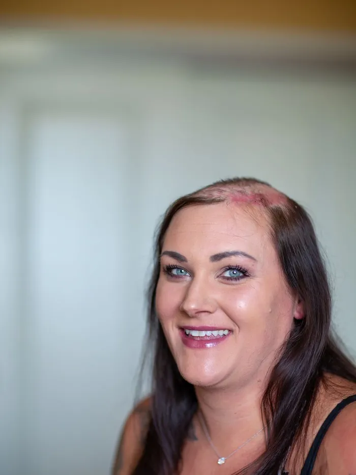 Before: a large bare patch across the front hairline and crown, hair still growing at the sides