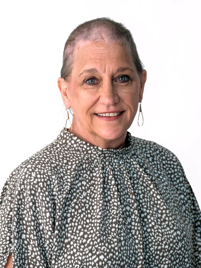 Before: near total hair loss across the top of the scalp with visible scalp scarring, white studio background