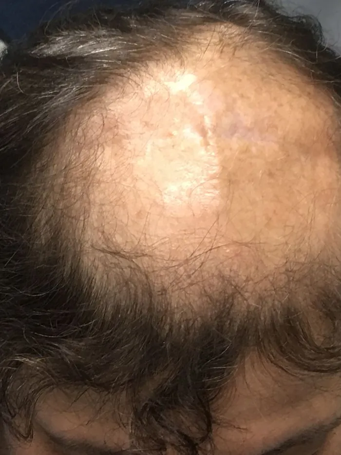 Before: advanced diffuse thinning with bare, shining scalp across the whole top of the head and dark hair only at the perimeter