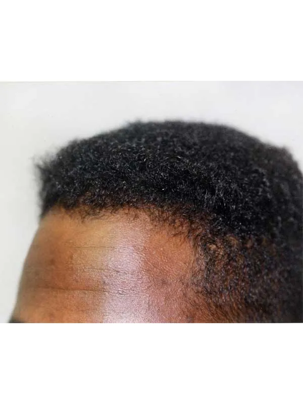Hair restoration result at National Hair Centers