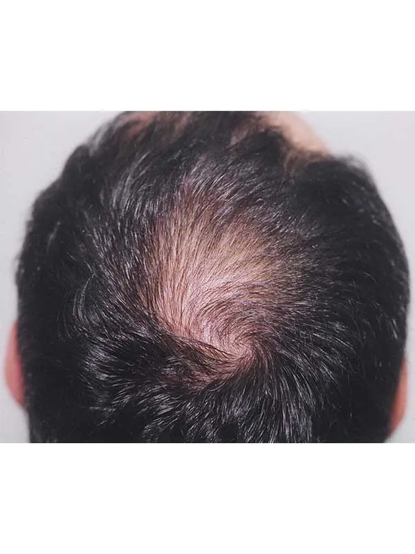 Hair restoration result at National Hair Centers