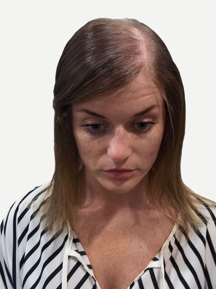 Before: diffuse thinning across the crown, front view on a white studio background