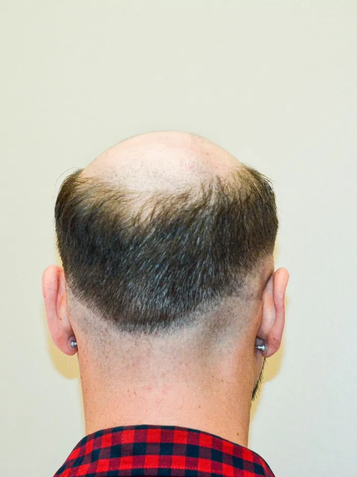 Before: hair loss through the crown and top, seen from behind against a pale wall