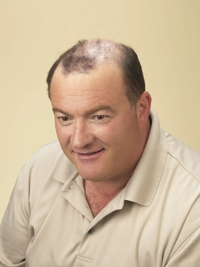 Before: receding temples and thinning through the mid-scalp, head tilted down, on a cream studio backdrop