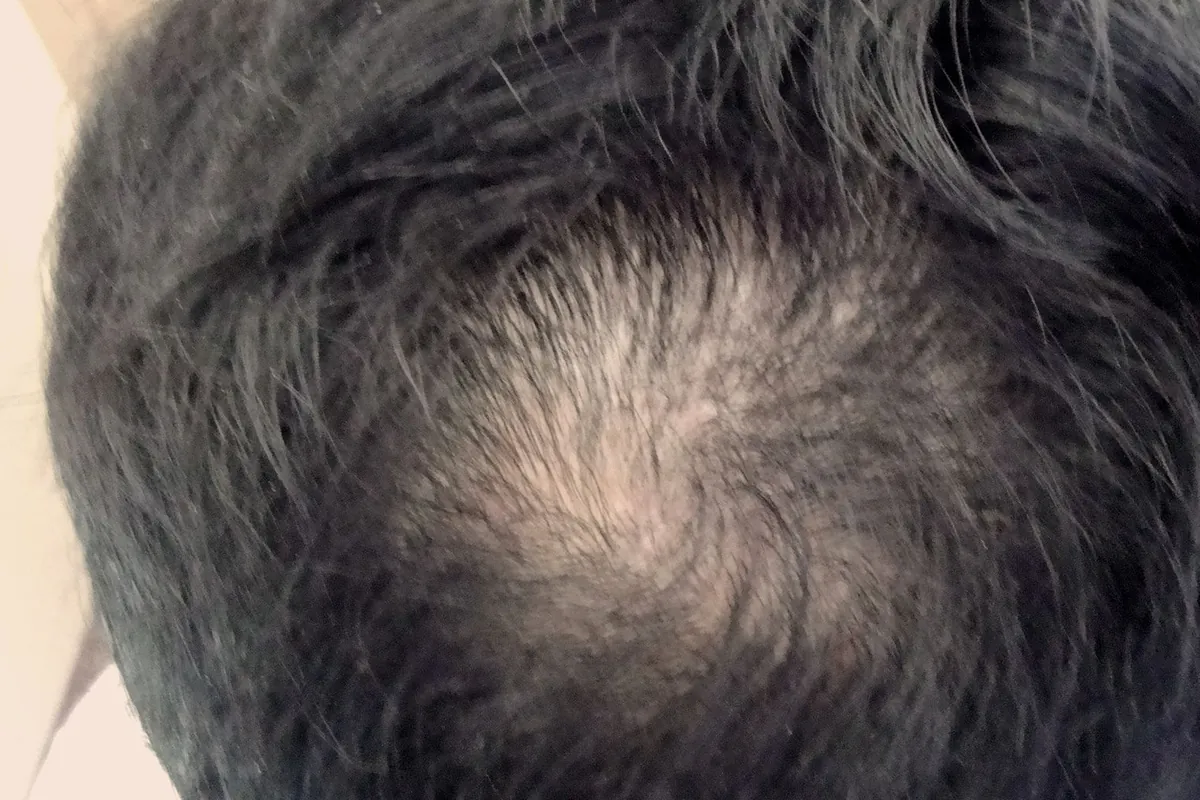 Top-down view of the crown, with the hair thinning out around the swirl so the scalp shows through