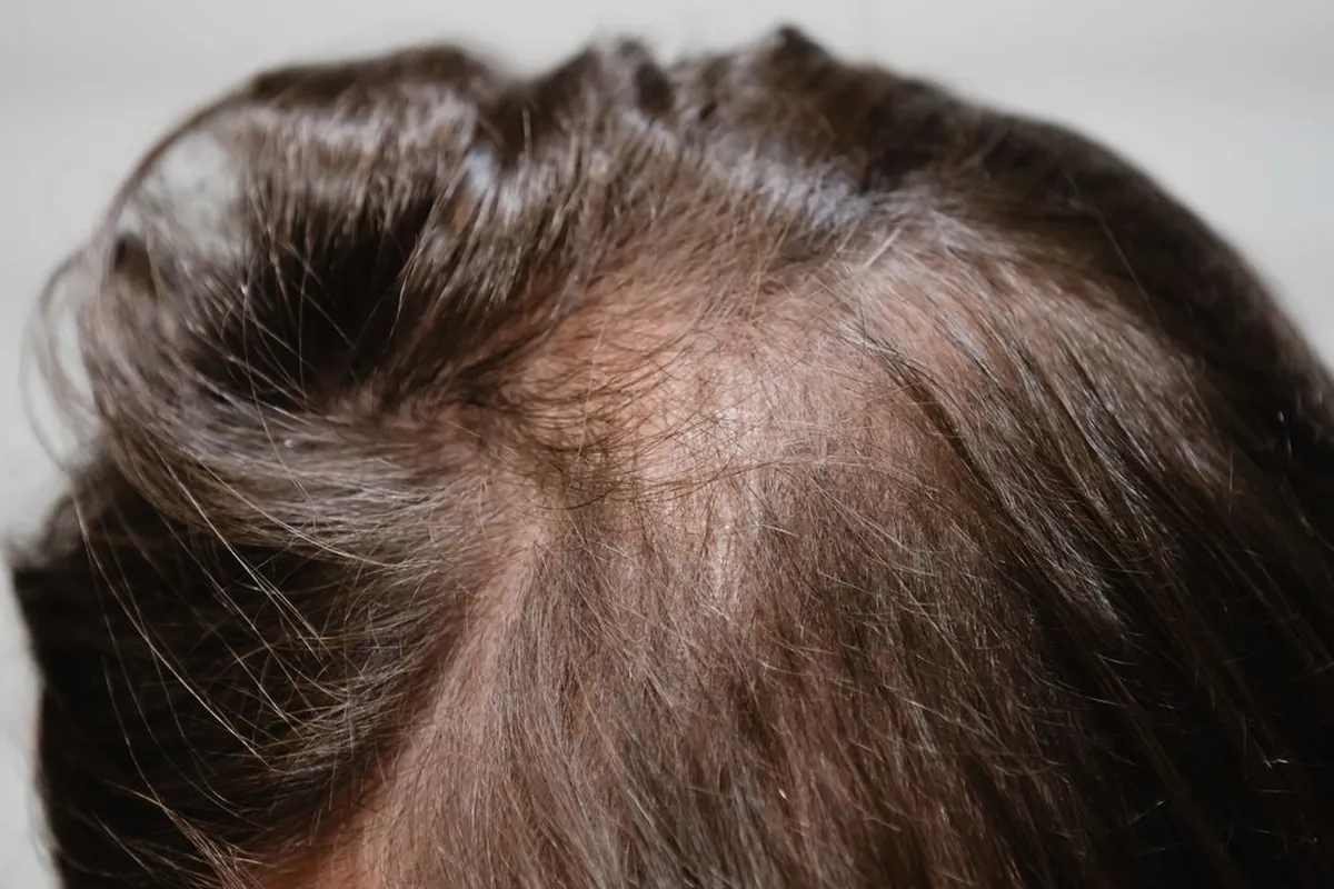 Top-down view of a young man's scalp with hair thinned evenly across the top and the scalp visible along the part