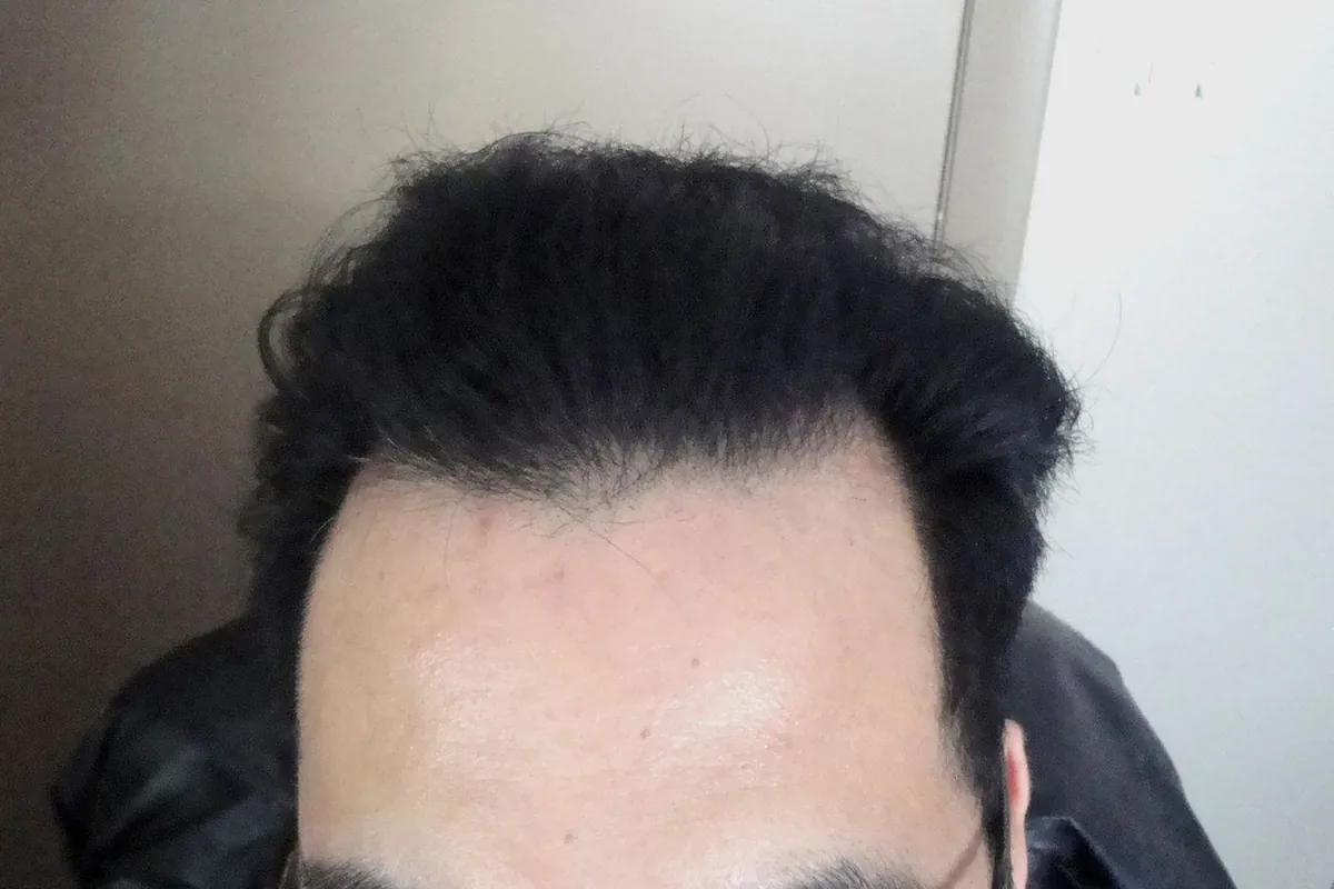 Front hairline seen from above, with the corners beginning to recede near the temples