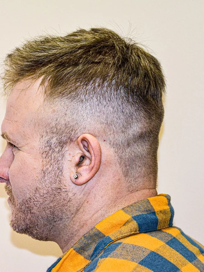 After: dense natural hairline with a non-surgical hair system