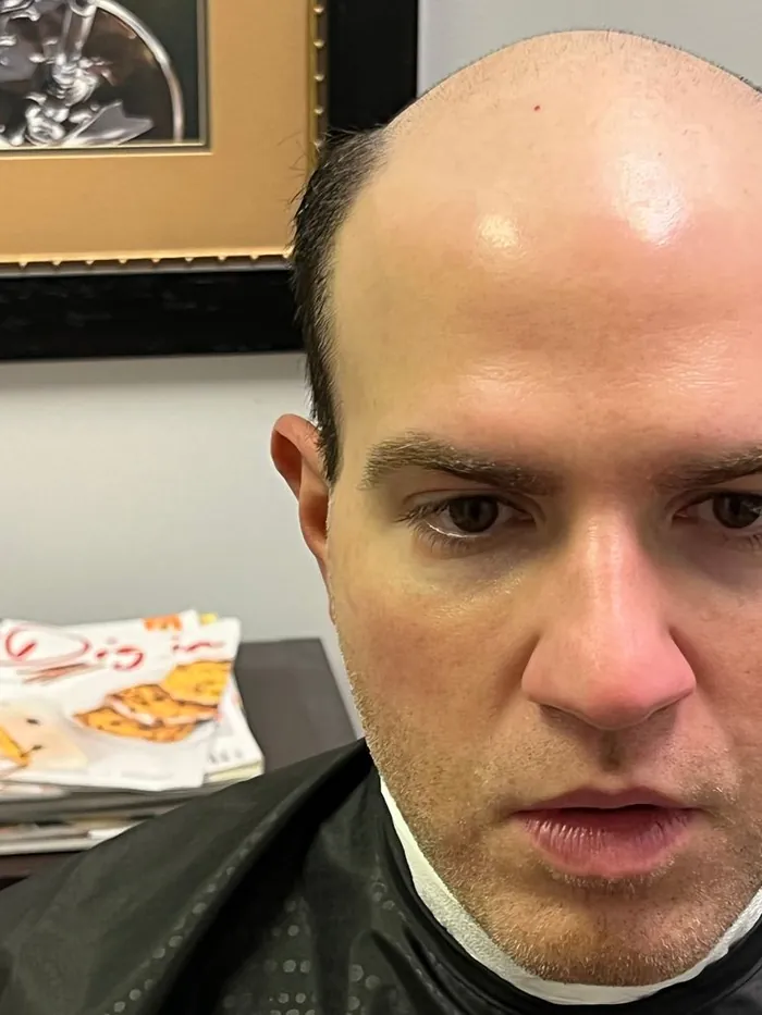Before: advanced crown and frontal hair loss in a man