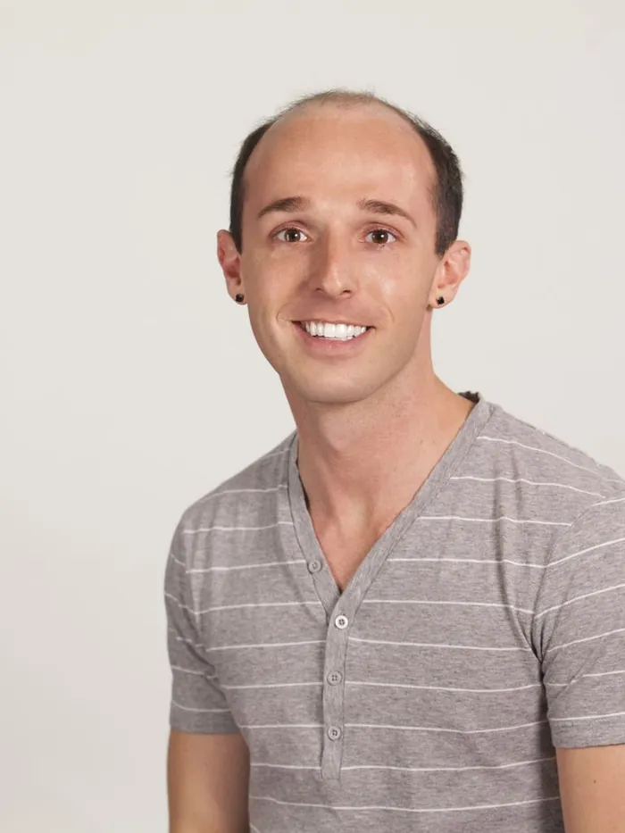 Before: thinning crown and receding temples from male pattern hair loss