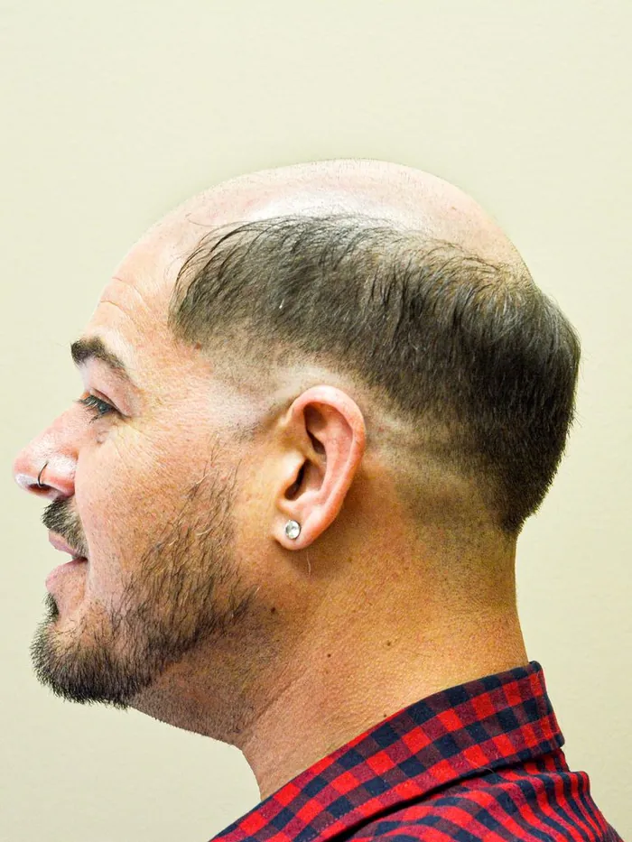 Before: receding hairline and thinning temples, side profile