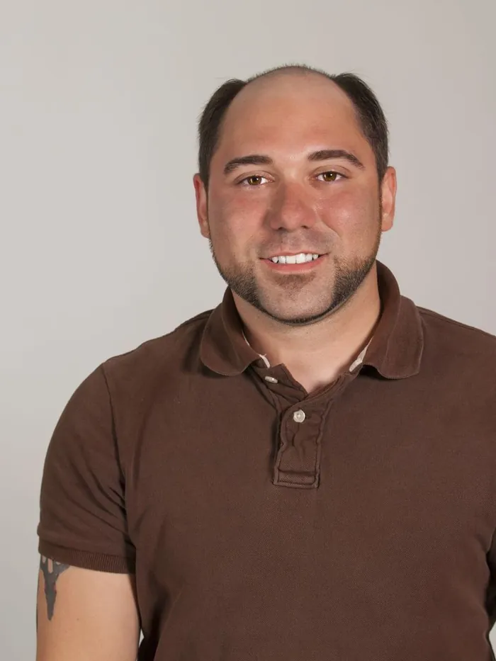 Before: diffuse thinning on top for a man in his 30s