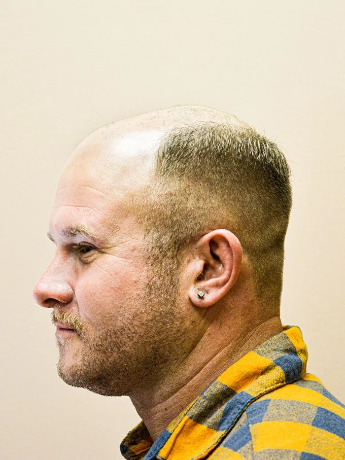 Before: thinning hair and visible scalp, side profile