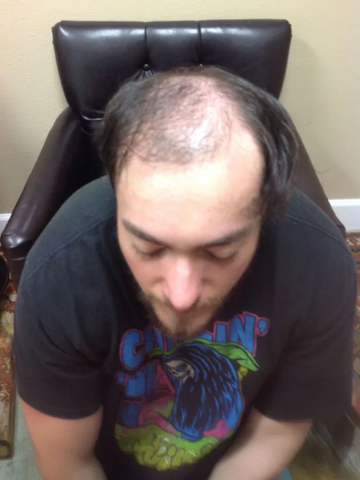Before: significant crown hair loss viewed from above