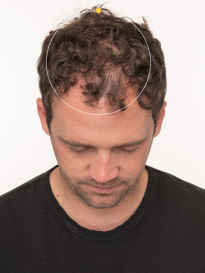 Real Nutrafol client before — visible hair thinning at the crown