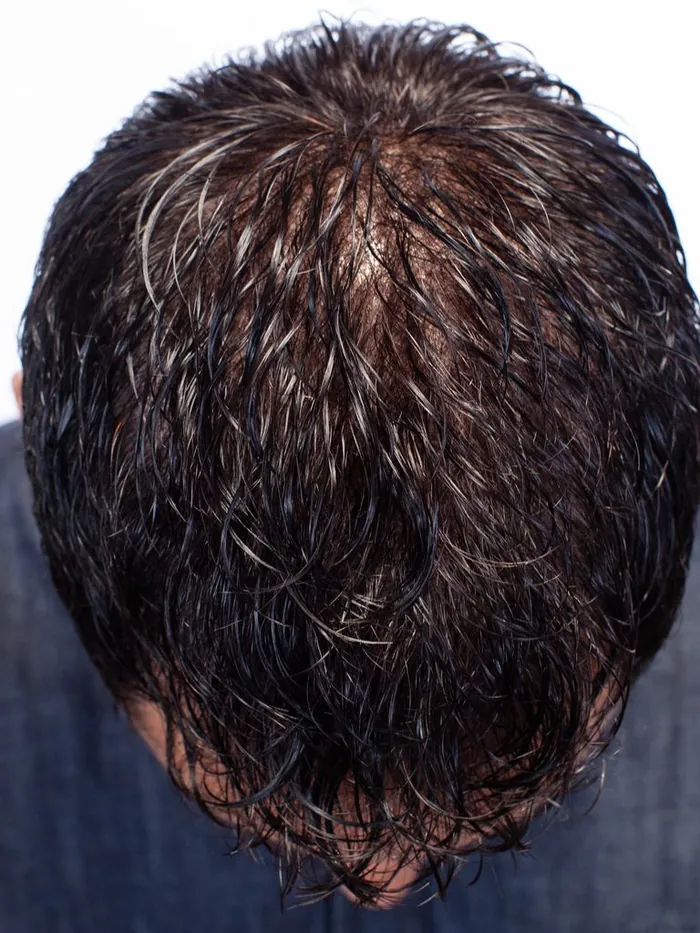 After: full crown coverage with a custom hair system viewed from above
