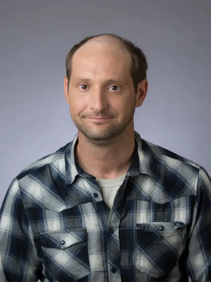 Before: extensive hair loss on top with a bald crown and thin sides, front view