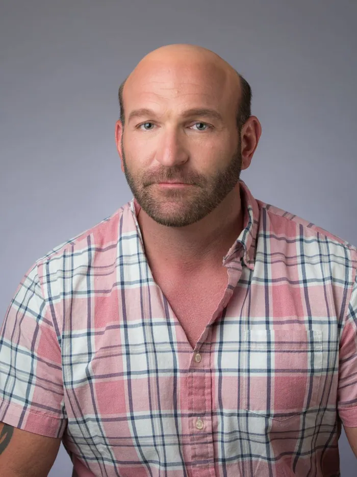 Before: complete hair loss on top with a shaved look, front view