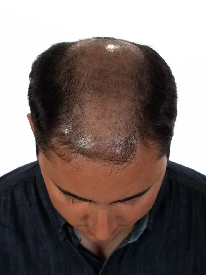 Before: crown hair loss and a receding front viewed from above