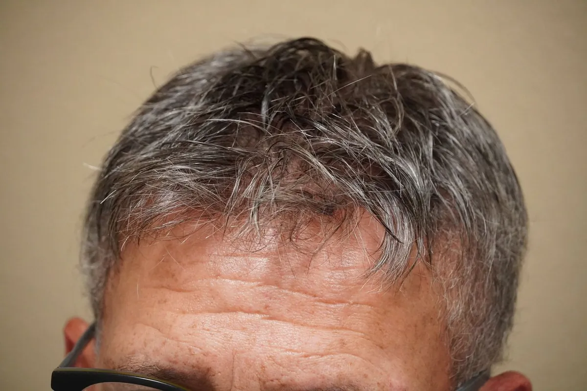 Close-up of a salt-and-pepper gray hairline on a mens hair replacement system with blended color