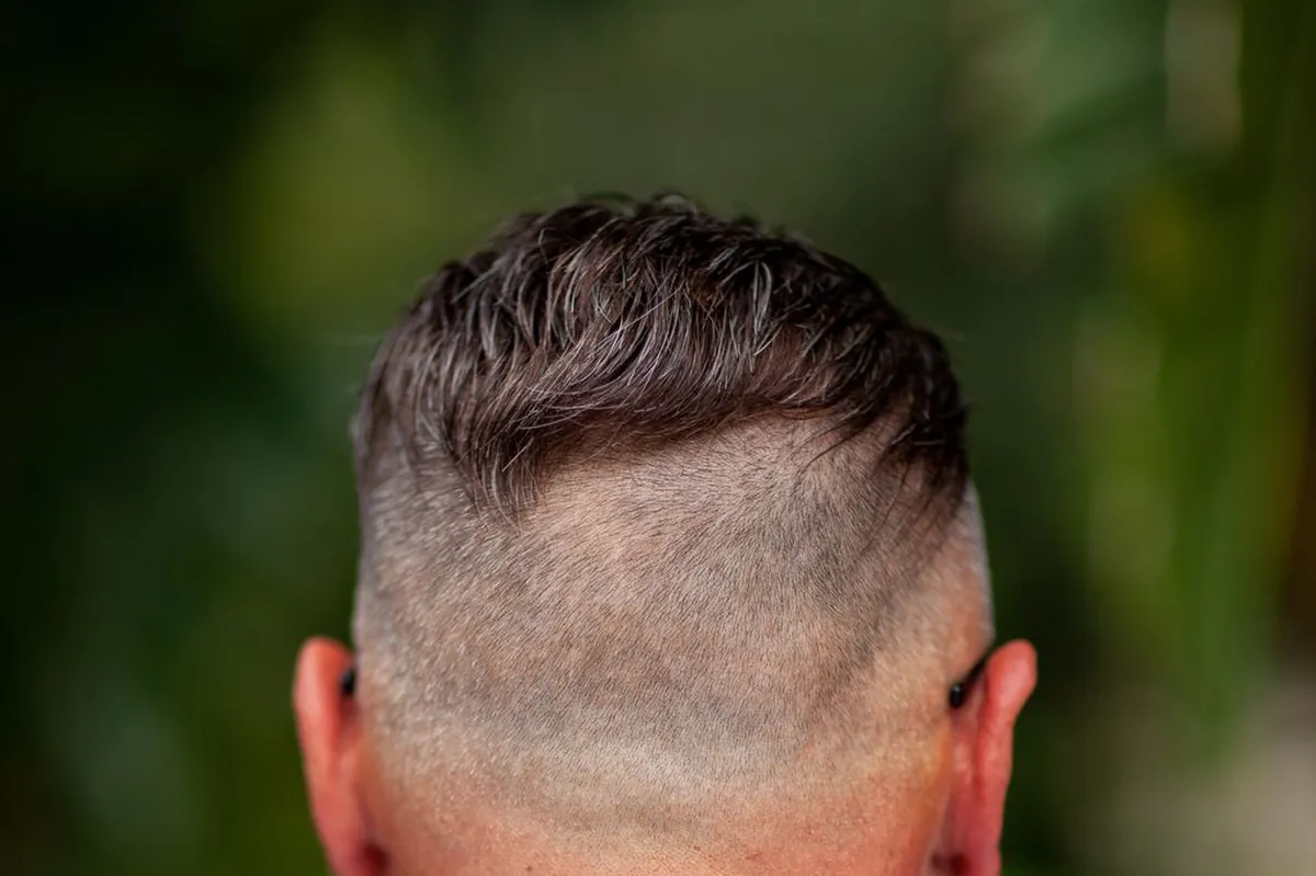 Back of the head showing a high skin fade rising into a mens hair replacement system with a clean nape blend