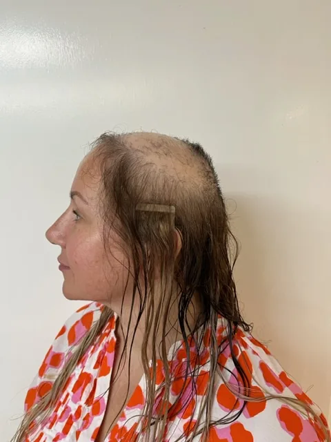Before side profile showing the extent of women's hair loss