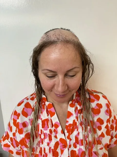Before close-up: sparse crown and thinning hairline from female hair loss
